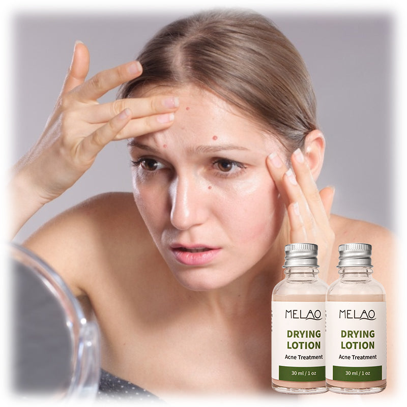 Natural Organic Acne Spot Pimple Treatment Cream