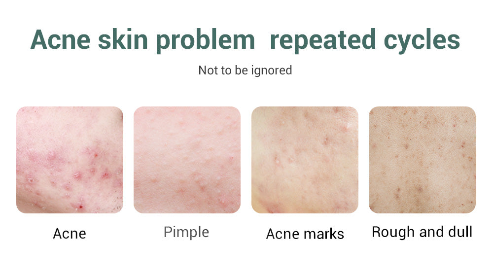 Metacnbeauty Sample Acne Treatment Serum