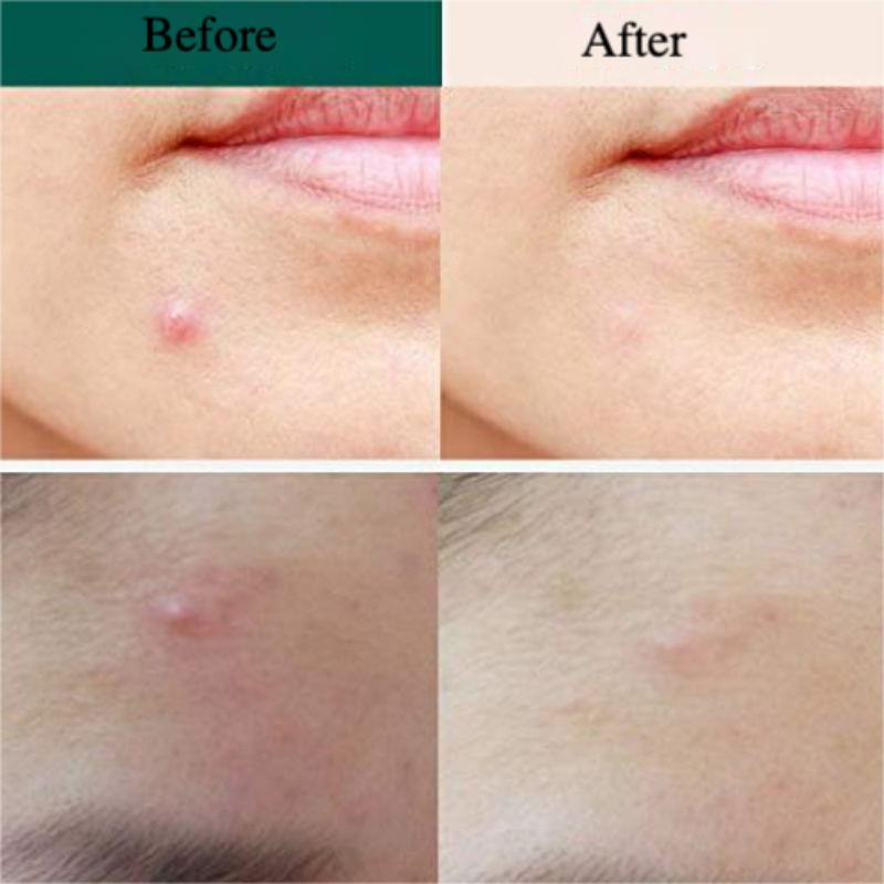 Private Label Microneedle Acne Patch