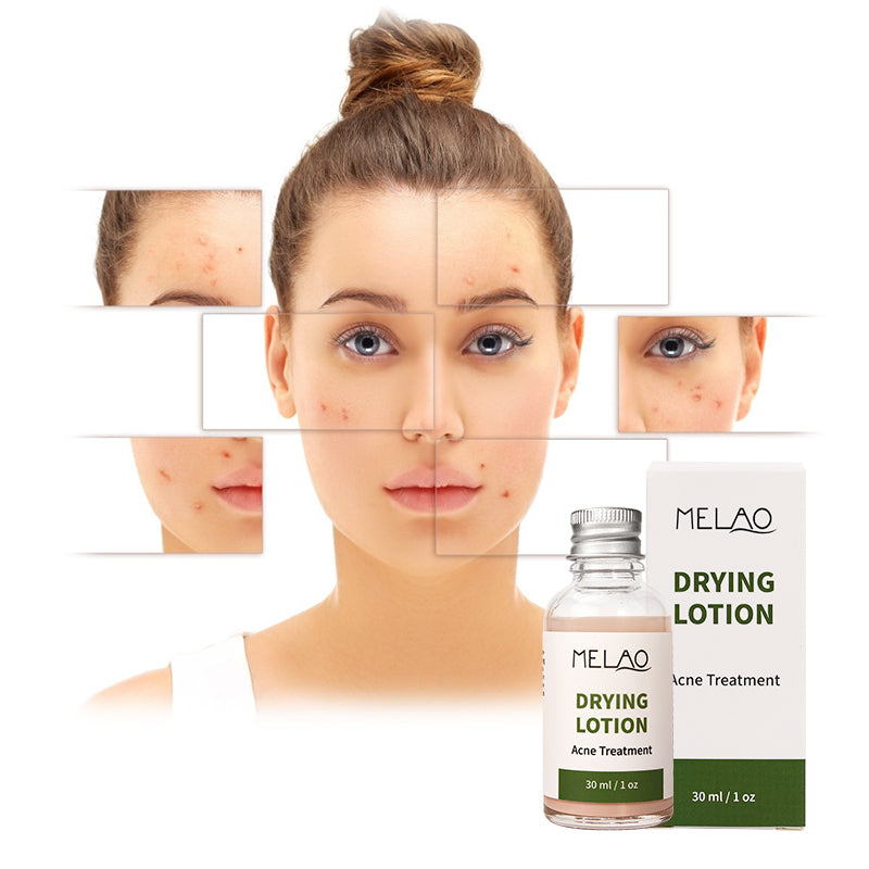Natural Organic Acne Spot Pimple Treatment Cream