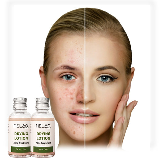 Natural Organic Acne Spot Pimple Treatment Cream